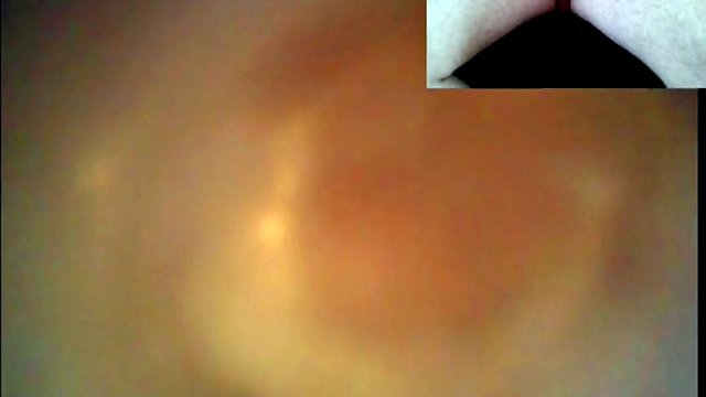 Traveling through the urethra with two chambers